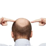 FlyHealth haartransplantatie in Istanbul