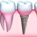 Wat zijn de voordelen van tandheelkundige implantaten?