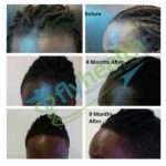 Jamie's haaruitval probleem is opgelost door middel van Afro haar transplantatie Istanbul