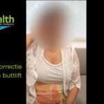 Liposuctie, Buikwandcorrectie en Brazilian buttlift Turkije