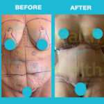 Abs-olutely Fabulous! mommy makeover turkije istanbul