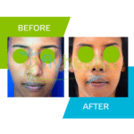 Ethnische Rhinoplastie Review bij FlyHealth