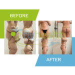 360° Lower Body Lift of 360 graden buikwandcorrectie