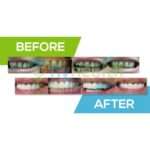 Glimlachen Transformeren, Levens Veranderen: Cahan en Lianne’s Hollywood Smile Reis