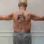 vera armlift after
