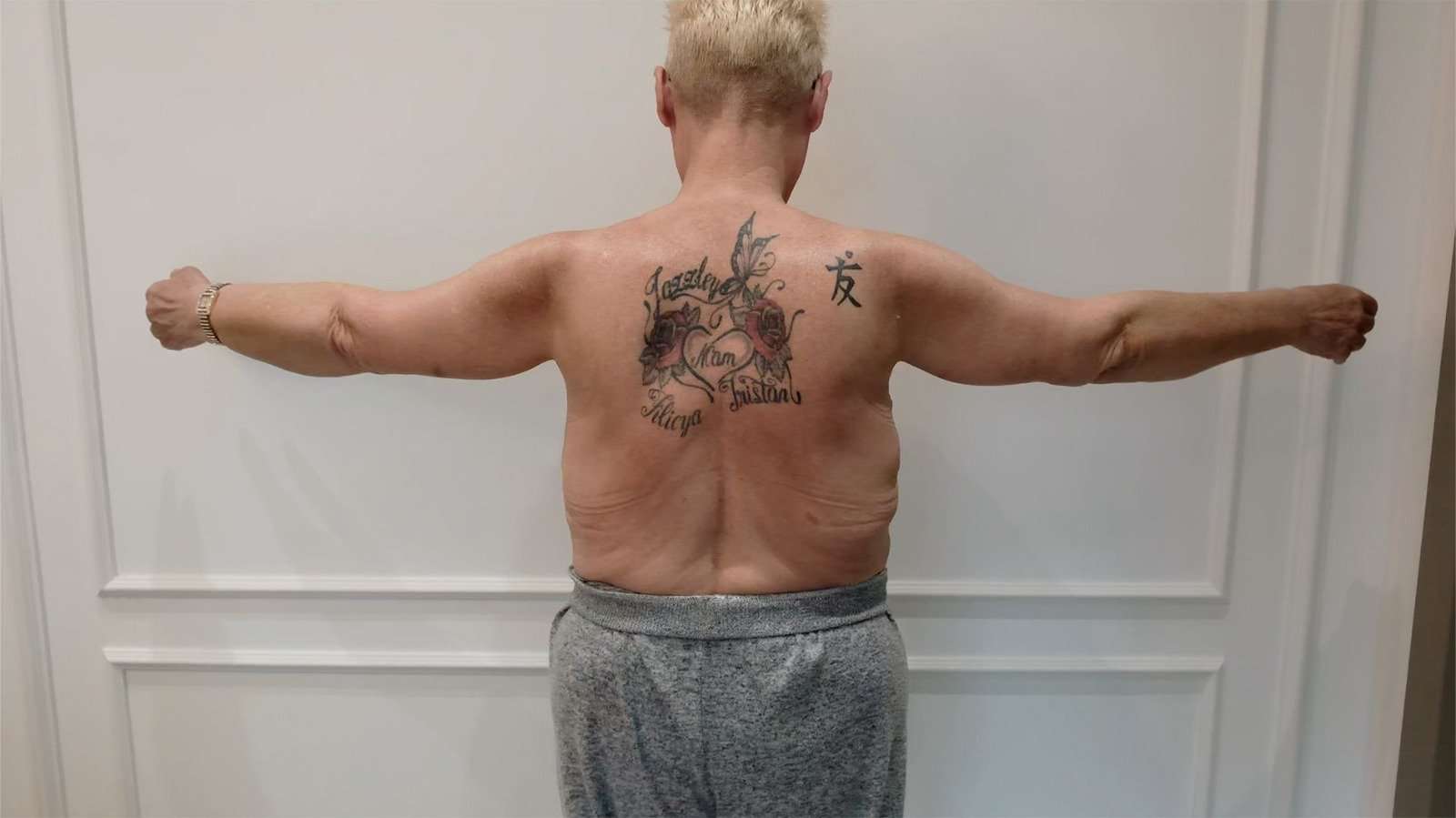 vera armlift after