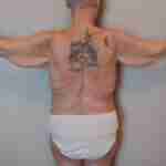vera armlift before