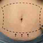 Wat is Vaser liposuctie?