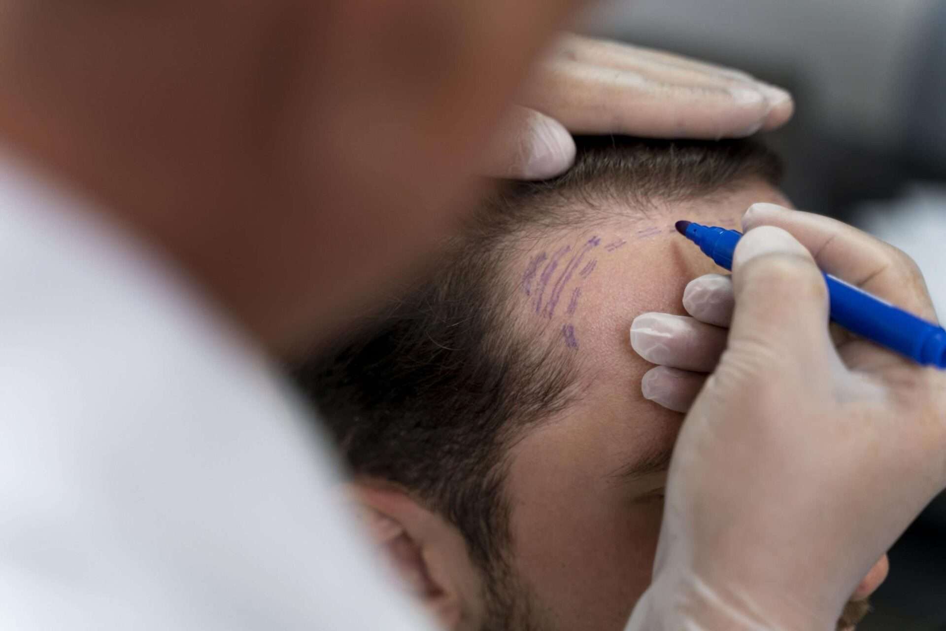 voorbereiding haartransplantatie