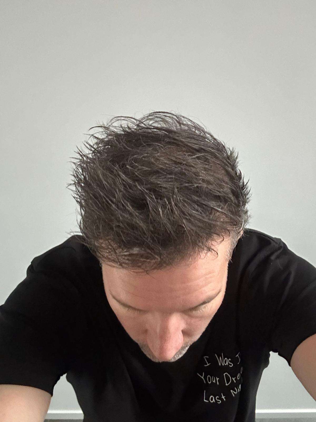 haartransplantatie voor en na