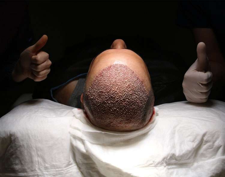 haartransplantatie in Turkije