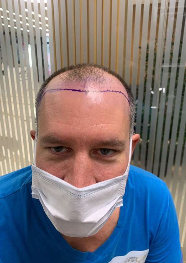 haartransplantatie-voor-na