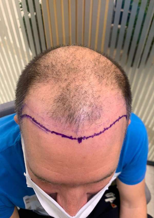 haartransplantatie-voor-na