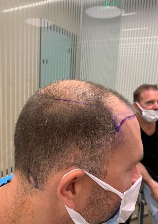 haartransplantatie-voor-na