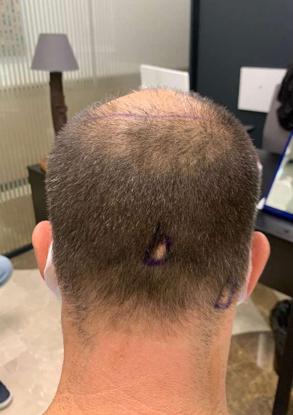 haartransplantatie-voor-na
