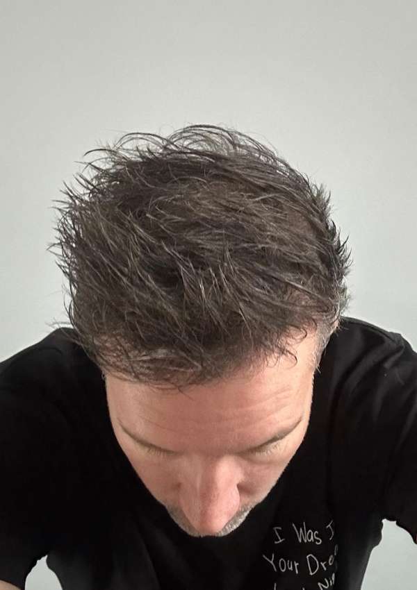 haartransplantatie-voor-na