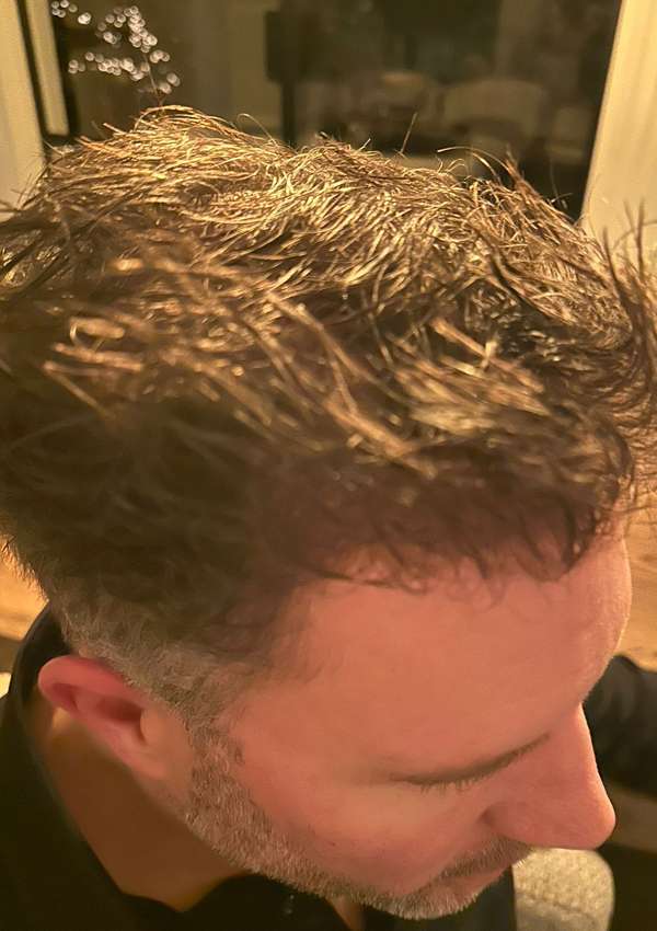 haartransplantatie-voor-na