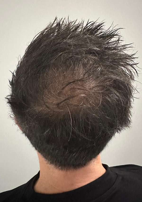 haartransplantatie-voor-na