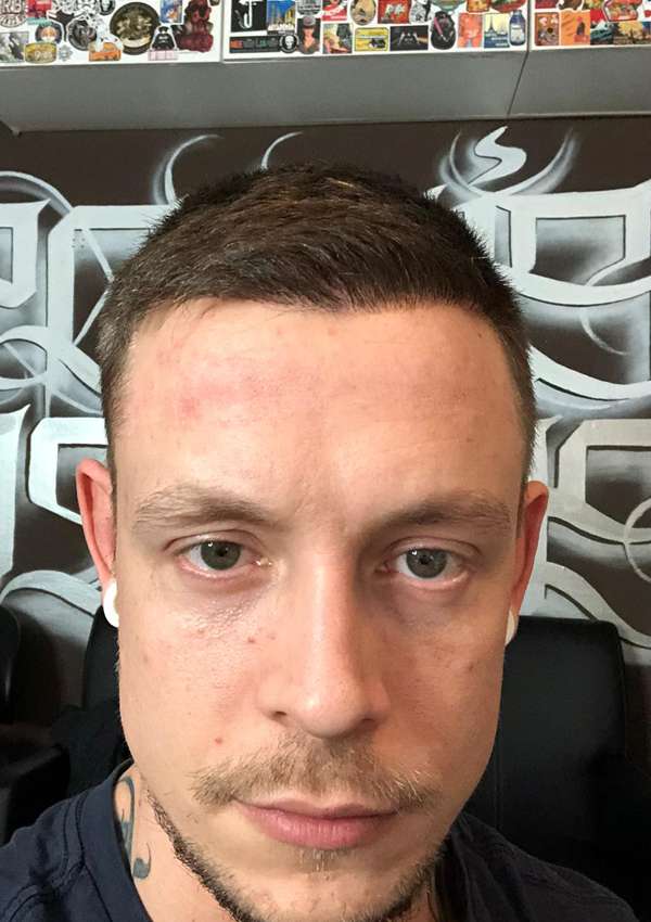 haartransplantatie-voor-na