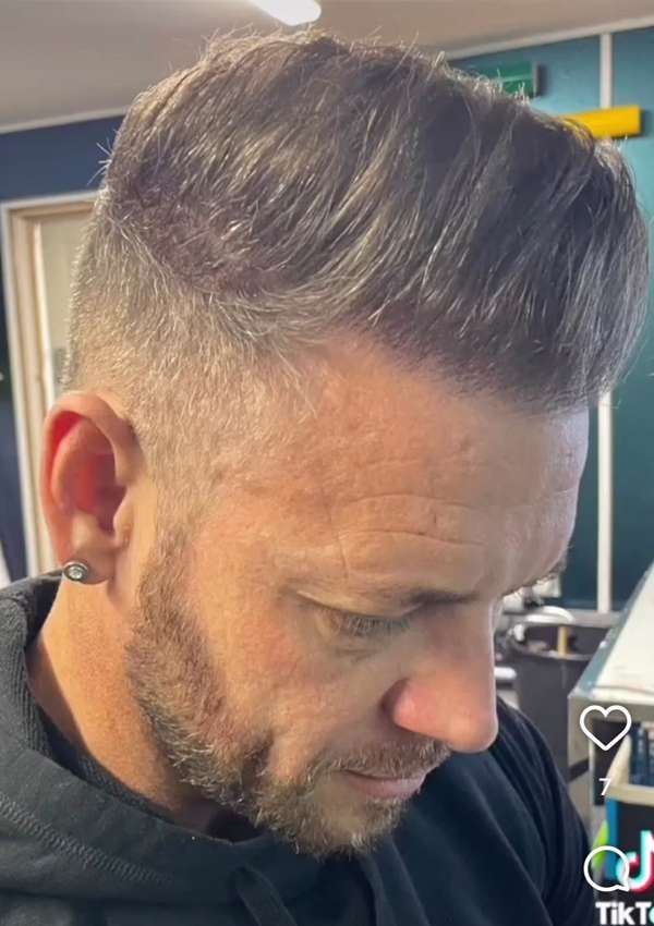 haartransplantatie-voor-na
