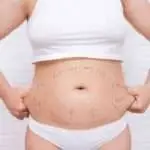 Alles wat je moet weten over Mommy Makeover kosten in Turkije