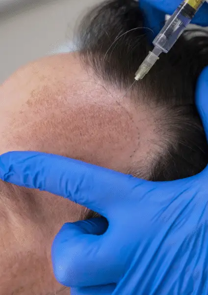 FUE saffier haartransplantatie turkije