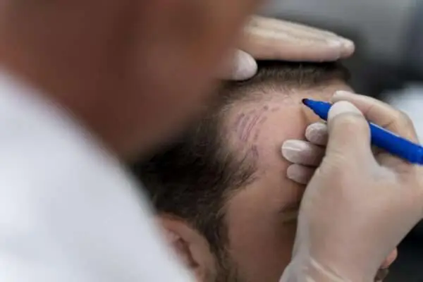 voorbereiding saffier FUE haartransplantatie