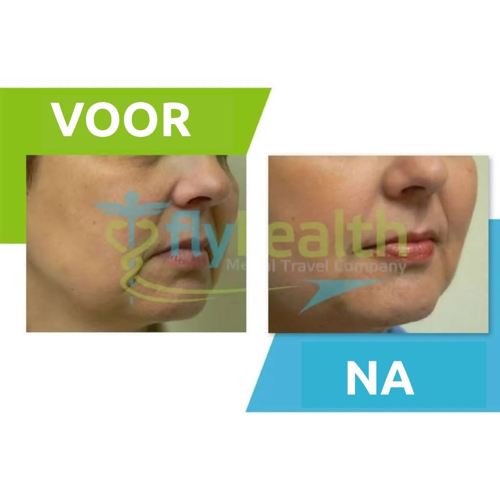 before and after