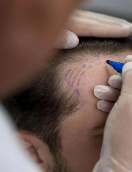 HAARTRANSPLANTATIE-Mobile