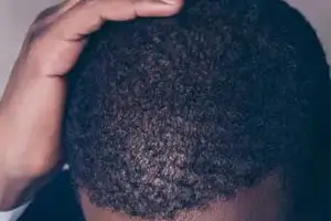 afrohairtransplant-2