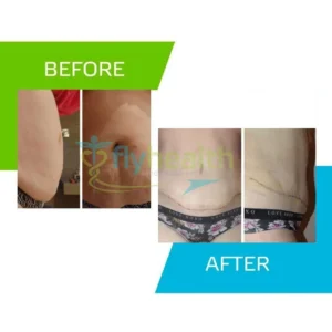 beforeafter