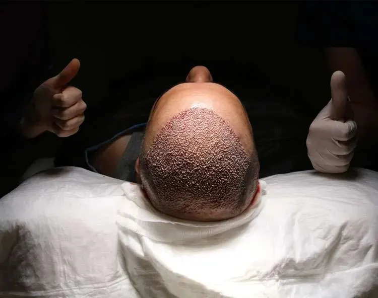 hairtransplant-1 (1)