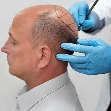 hairtransplant (1)