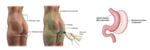 liposuction-vs-gastric-sleeve-in-Istanbul