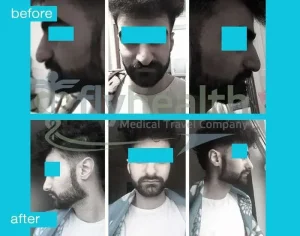 before-after-nose-surgery-15 (1)