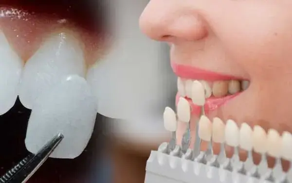 dental-veneers (1)