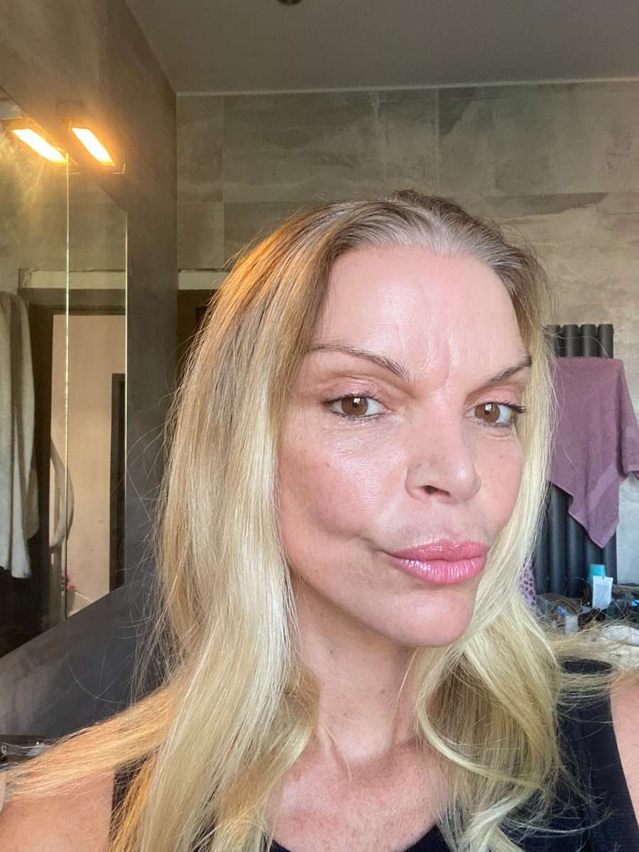 Martine, facelift in Turkije, 2 maanden na de operatie