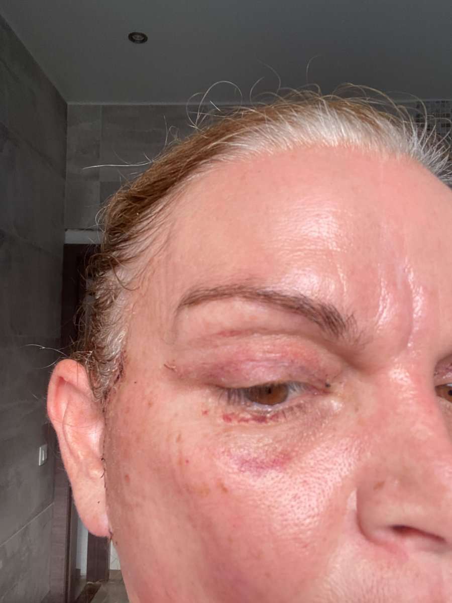 Martine, facelift in Turkije, 2 weken na de operatie