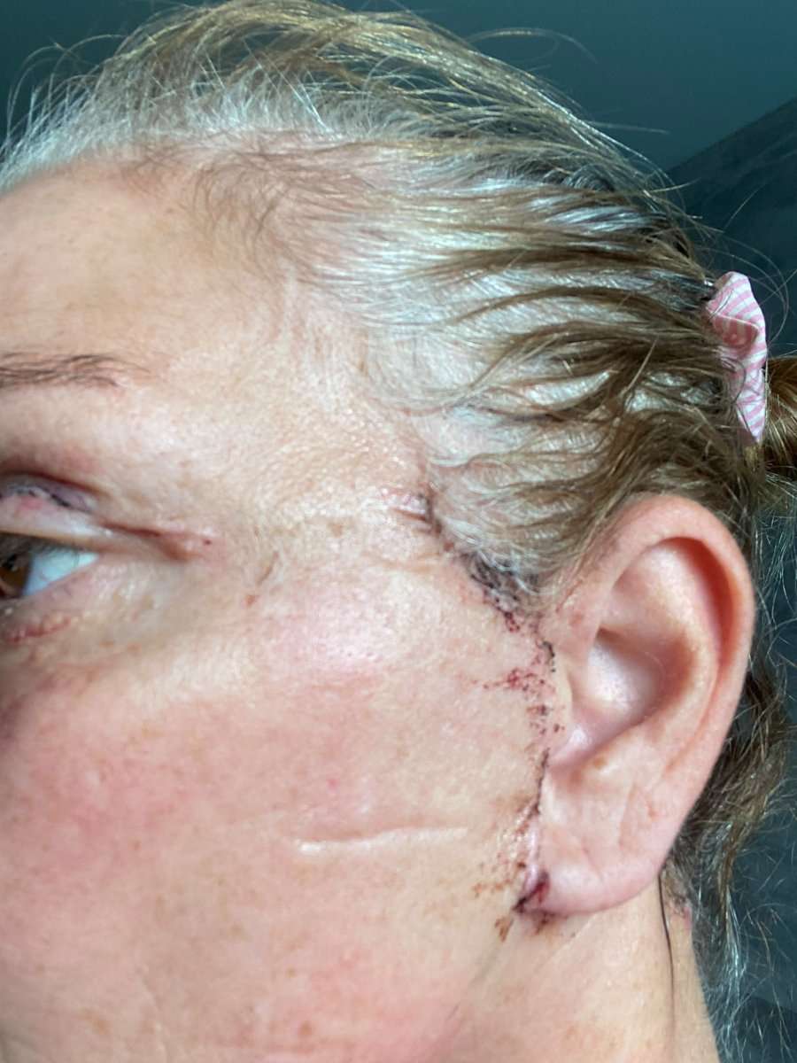 Martine, facelift in Turkije, 2 weken na de operatie