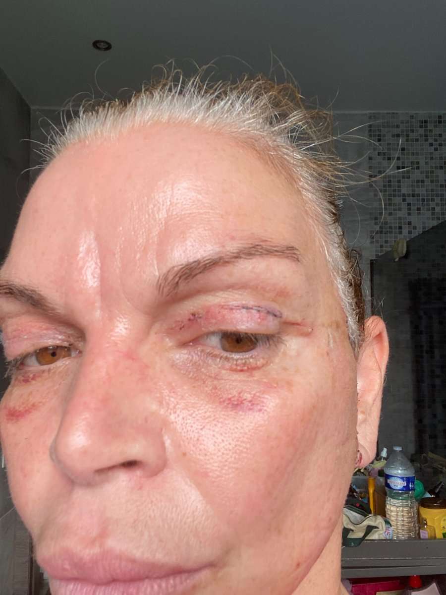 Martine, facelift in Turkije, 2 weken na de operatie