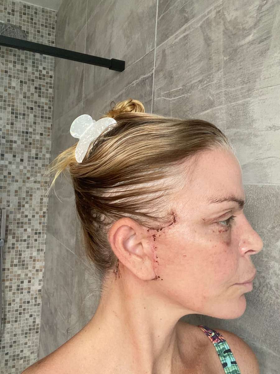 Martine, facelift in Turkije, 2 weken na de operatie