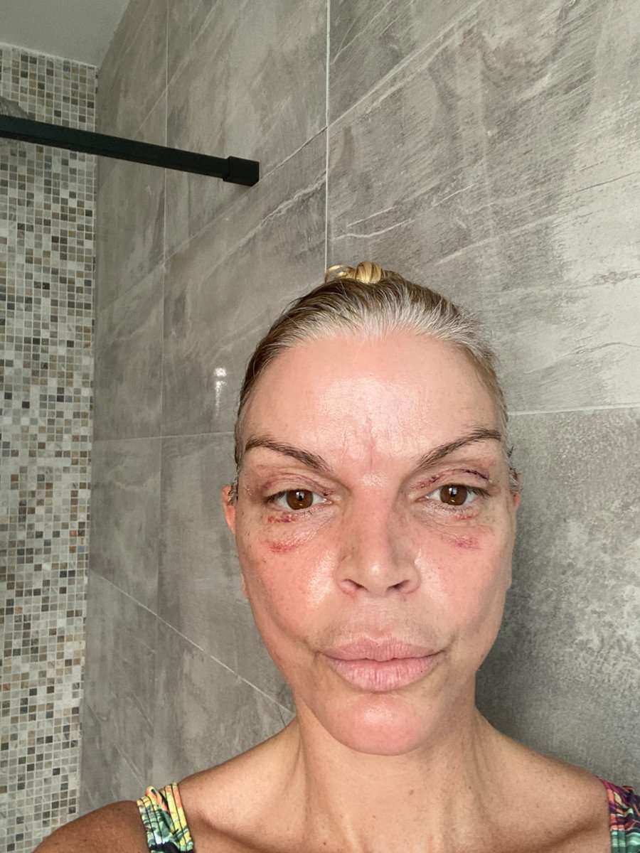 Martine, facelift in Turkije, 2 weken na de operatie