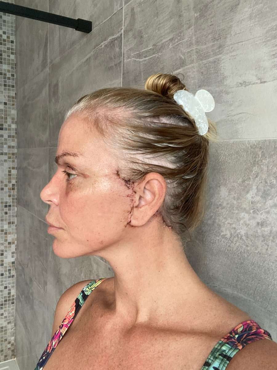 Martine, facelift in Turkije, 2 weken na de operatie