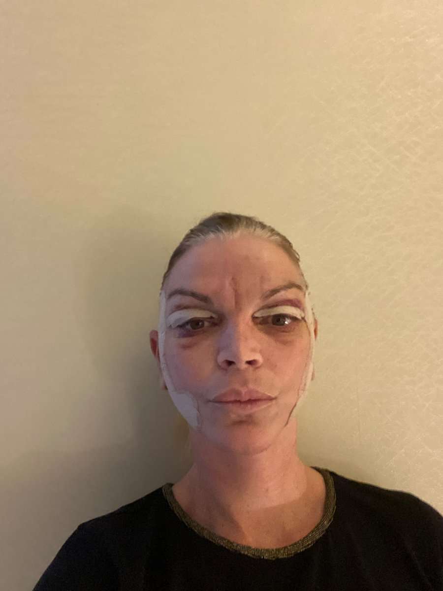 Martine, facelift in Turkije, 5 dagen na de operatie