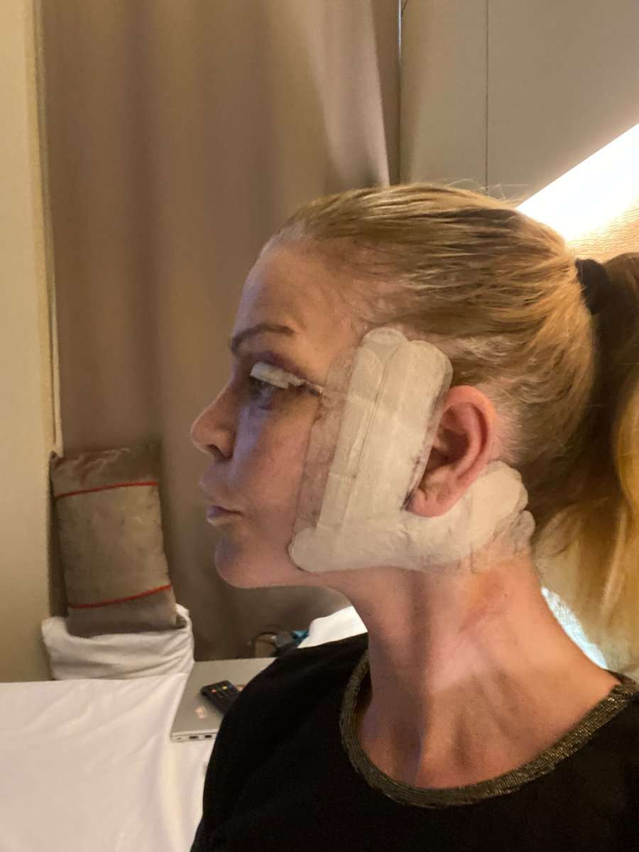 Martine, facelift in Turkije, 5 dagen na de operatie
