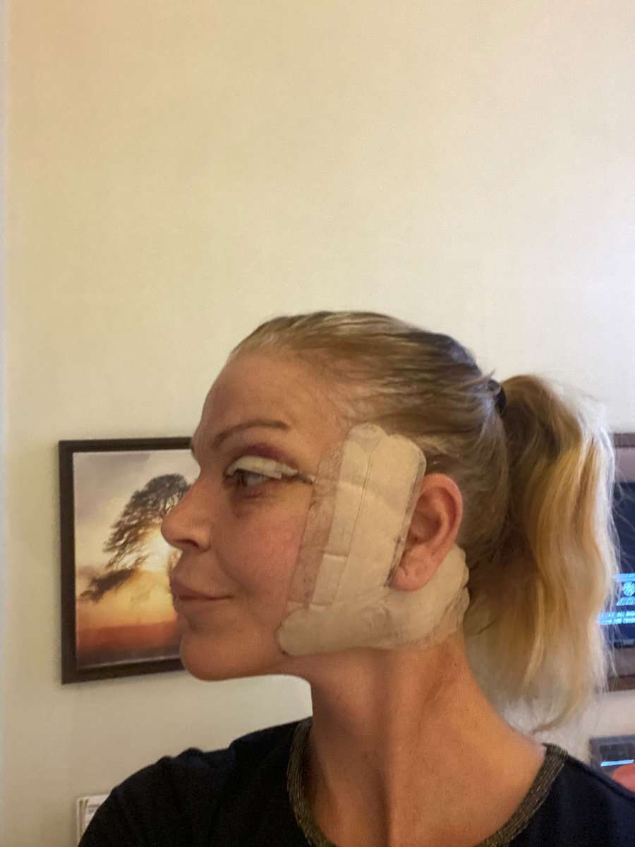Martine, facelift in Turkije, 5 dagen na de operatie