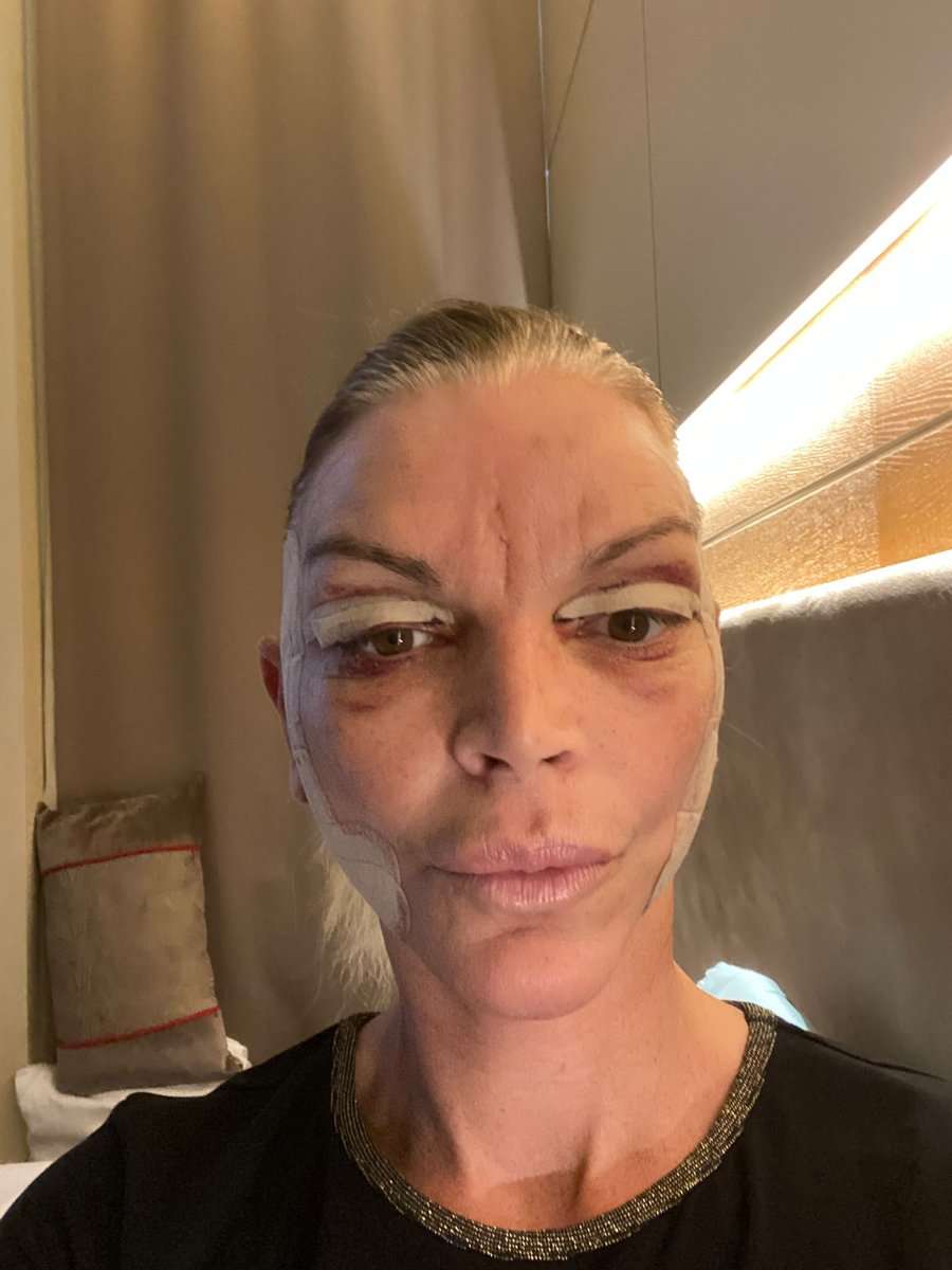 Martine, facelift in Turkije, 5 dagen na de operatie