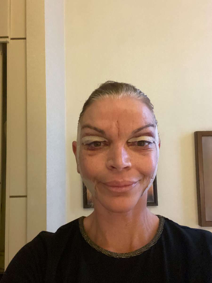 Martine, facelift in Turkije, 5 dagen na de operatie