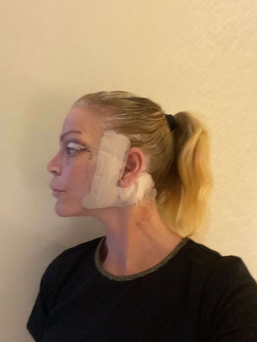 Martine, facelift in Turkije, 5 dagen na de operatie