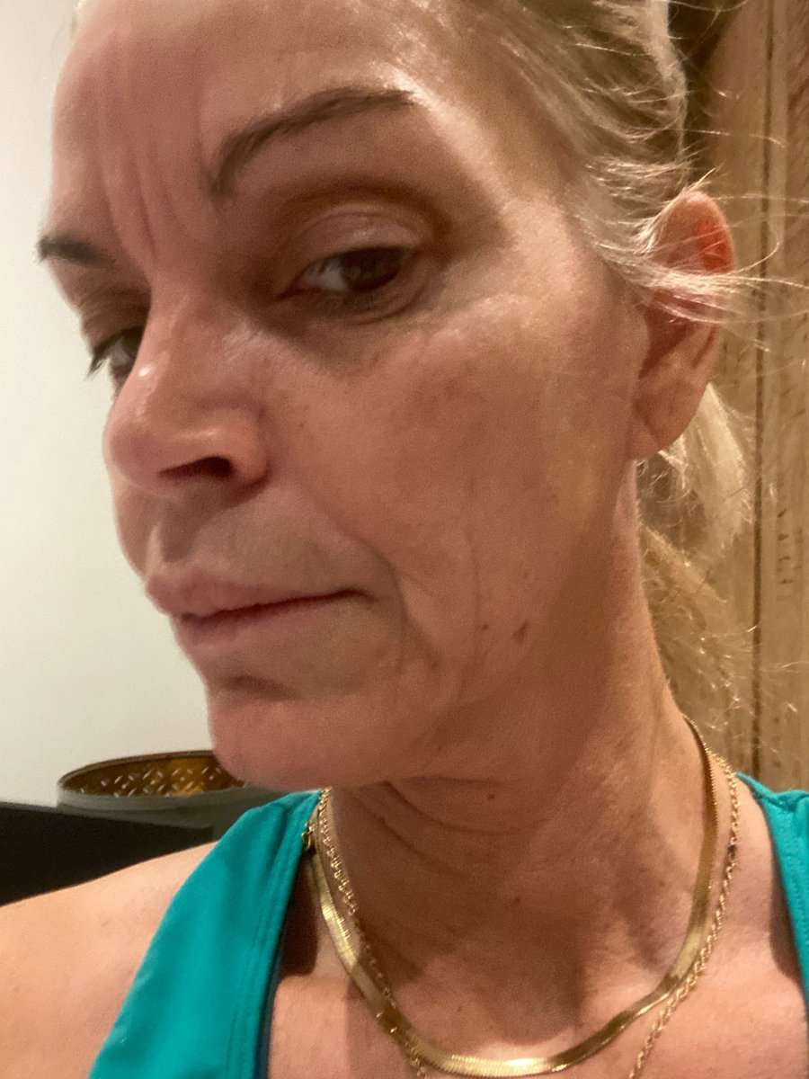 Martine, facelift in Turkije, voor de operatie